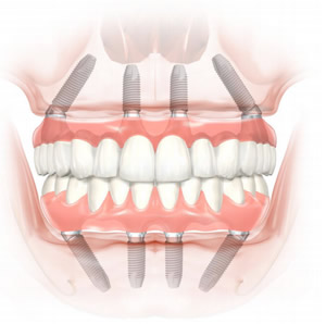 All-on-4：”総入れ歯”の方のためのインプラント